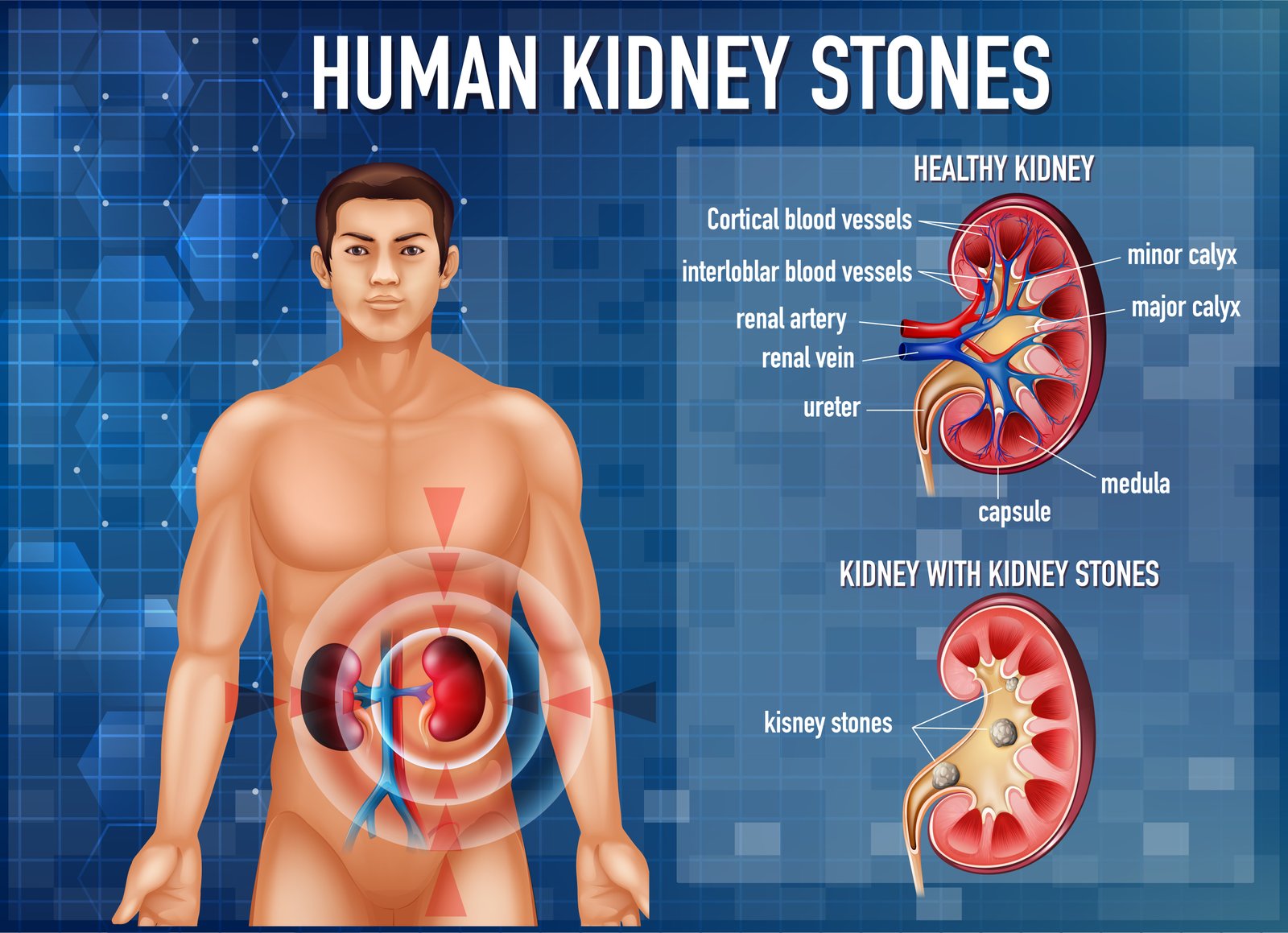 Kidney Care